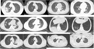 Case report: A clinical case study of six patients with Chlamydia psittaci pneumonia